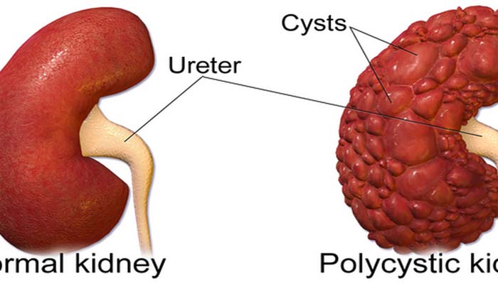 Tanda-tanda Penyakit Ginjal Polikistik yang Bisa Gagal Organ